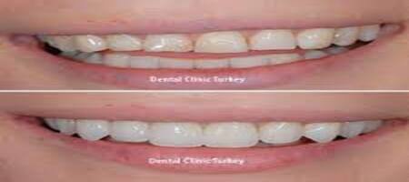 What are dental veneers? procedure in Turkey
